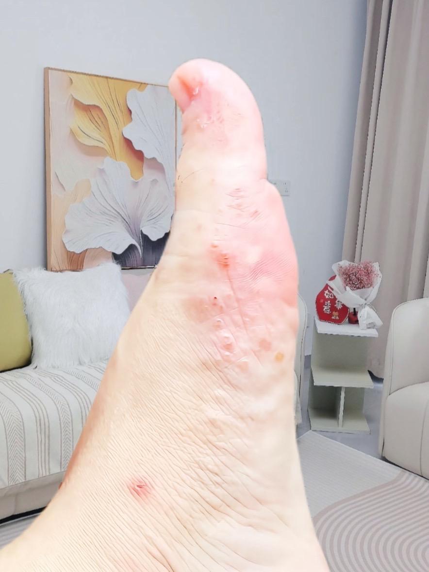 终于不痒了不臭了,老牌子用着放心#万万没想到 #脚 #无处安放的小jio #足部护理 #我的脚脚