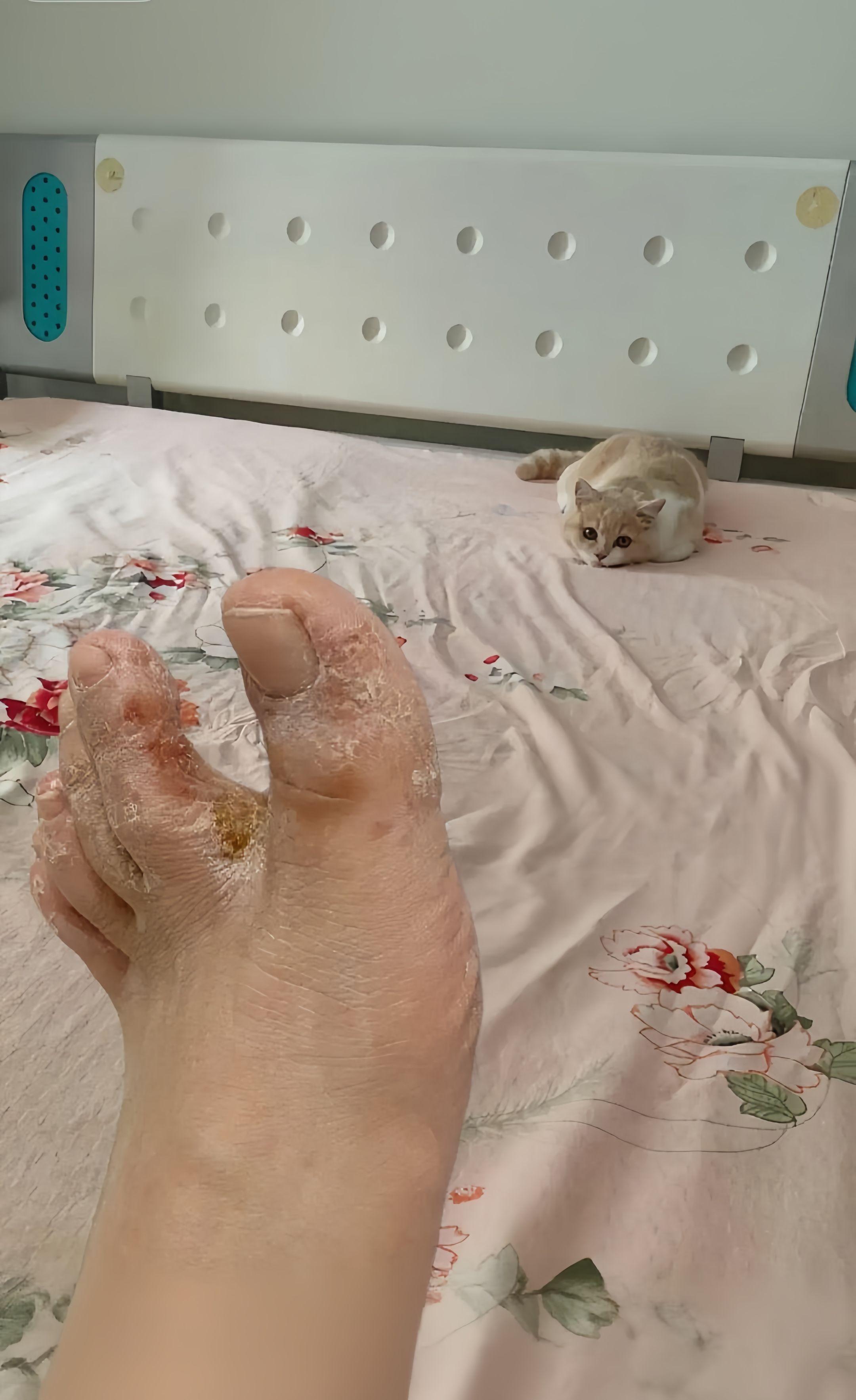 真菌脚,上线了#强烈推荐 #助手抖音 #足部护理