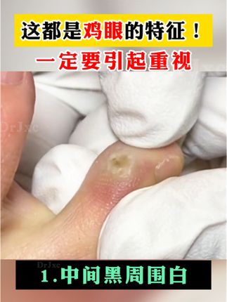 脚底这种情况是鸡眼,教你一个方法搞定它#鸡眼 #鸡眼跖疣 #鸡眼去除小妙招 #鸡眼机 #鸡眼扣