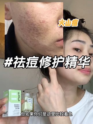 不要摇晃它 直接用棉签触底点涂在脸上就可以 #痘痘肌 #护肤好物 #自用好物推荐 #痘印 #痘坑