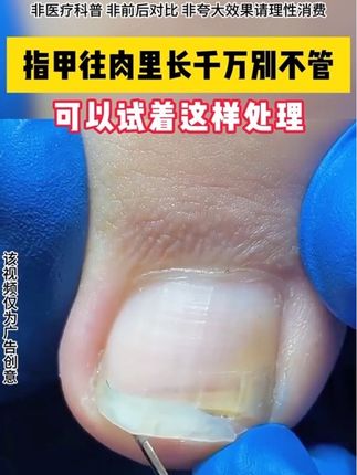 指甲往肉里长,可以试试这个小方法#脚指甲往肉里长怎么办 #嵌甲