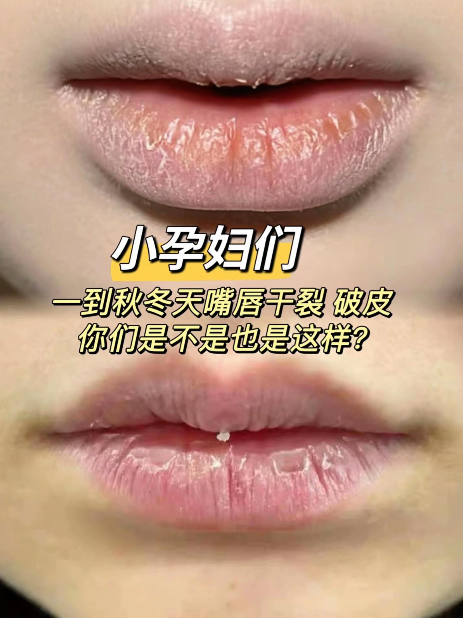 孕期唇部护理!袋鼠妈妈润唇膏锁死秋冬天气孕后嘴干到爆?这支上嘴巨滋润还不粘腻 成分安心,现在买一送一太划算! 两支够用到卸货,嫩唇轻松拿捏~#袋鼠妈妈 #润唇膏#润唇膏推荐 #孕妇润唇膏#唇部护理