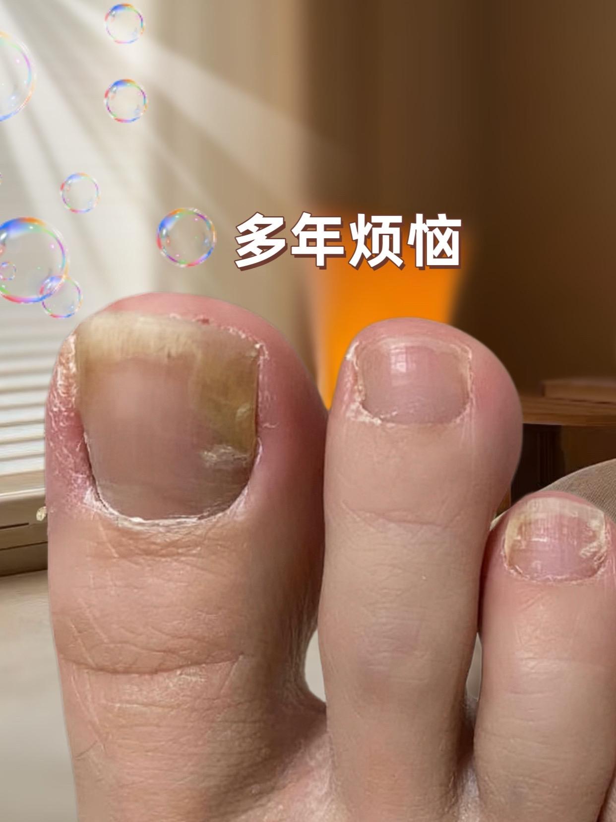 #灰指甲 #强烈推荐 #亲测分享 #自用好物分享 #爱了爱了 尝试一下,终于上岸