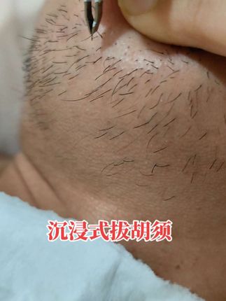 #胡须夹子 #解压拔胡子 #解压视频 #胡须 #童大鸭梨