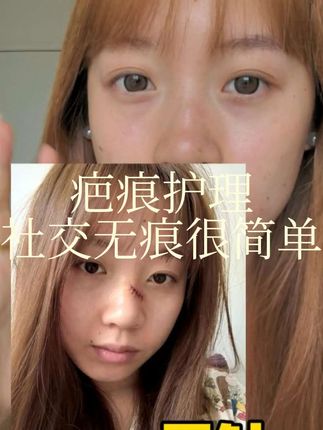 疤痕初期真的很重要,一定要重视起来呀,宝宝们问的#美皮护 今天挂在左下角啦!#切痣 #疤痕护理