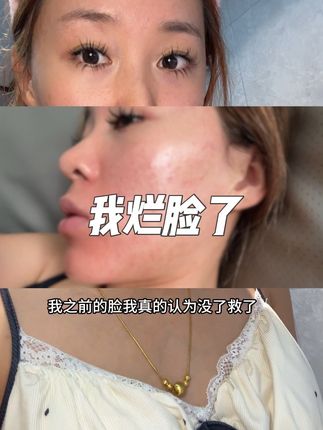对T区黑头白头、闭口、毛周角化、毛孔粗大、淡化痘印 信我的你就坚持用 #dou上热门 #澳洲肤润康壬二酸 #壬二酸 #脂皮 #闭口 @抖音小助手