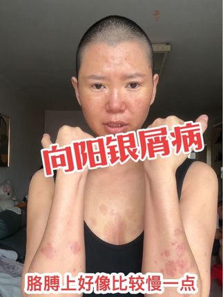 目前的使用的方法达到的效果还是比较理想的!希望继续见好!我们一起坚持!#向阳银屑病 #牛皮癣 #银屑病