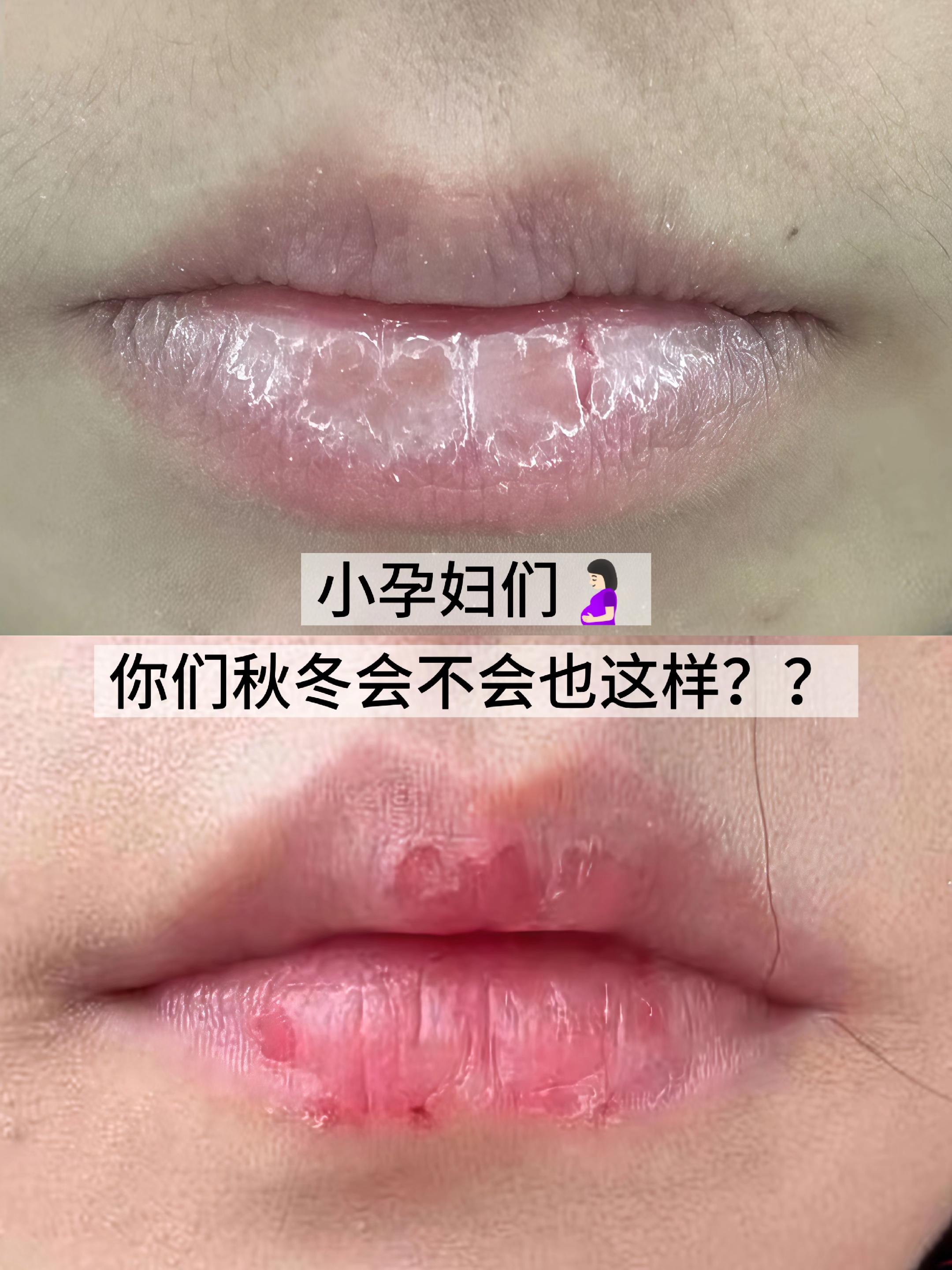 孕期嘴巴干到起皮、涂口红卡纹超影响心情?别愁!袋鼠妈妈这款润唇膏来帮你解决~ 核心成分是小麦胚芽油,天然温和超亲肤,用着超安心。涂上去瞬间滋润,像给嘴唇裹了层软膜,干裂起皮全不见,嘴唇水嘟嘟超软嫩。现在买一送一超划算,孕期也能拥有好唇态~ #袋鼠妈妈 #孕期护唇 #润唇膏 #滋润保湿 #护唇