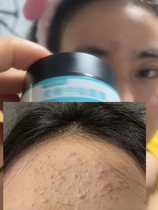 #青春痘#痘痘毛孔粗大痘坑痘印#黑头毛孔