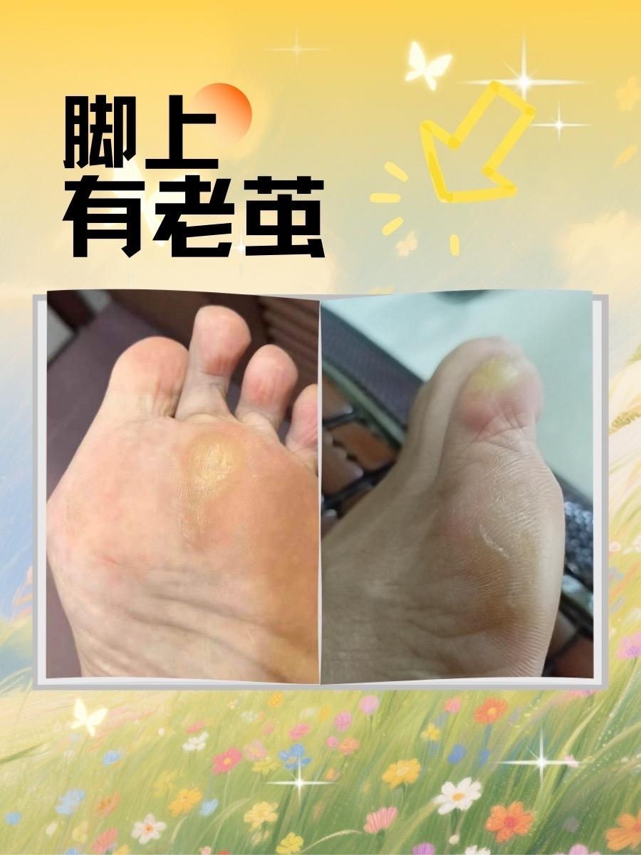 老茧子脱落啦。老茧不要再修不要再剪#老茧 #手茧 #鸡眼 #老茧软化剂 #脚茧