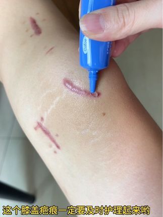 这款可孚疤痕贴,现在升级了又薄又软又透气 可以随意的去裁剪,平时疤痕痒的都可以用,越早用淡化效果越好,家人们用起来吧#疤痕护理