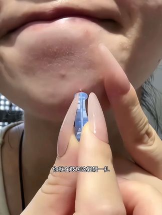 这个一次性的,可比大头针好用太多了!关键还便宜!老爱手欠挤包包的,就用这种比头发丝还细的次抛,干净卫生还方便#女生必备#痘痘肌#清洁工具#我捡到宝了#种草