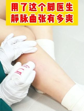 腿上青筋凸起红血丝的,用脚医生静脉曲张就知道有多好! #静脉曲张 #静脉曲张怎么办 #静脉曲张手术 #静脉曲张老烂腿 #静脉曲张微创