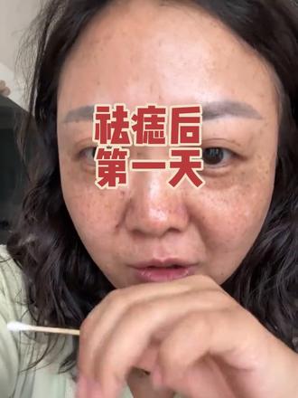 头上那颗大的今天还疼了几阵#祛痣后要注意什么