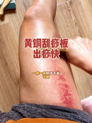 几乎没什么痛感,热热的很舒服 寒往下走,入秋后腿部六条经络一定要通一通#刮痧 #刮痧板 #家庭必备好物