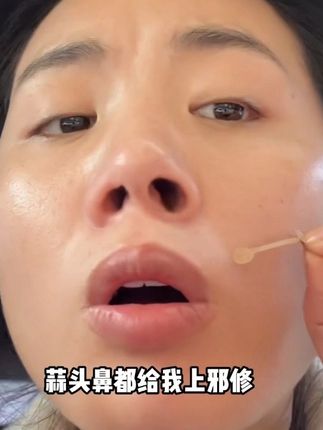 Wo趣,跟了我20多年的大蒜头鼻终于有救了!#鼻翼贴 #鼻翼肥大 #鼻翼贴测评 #亲测分享
