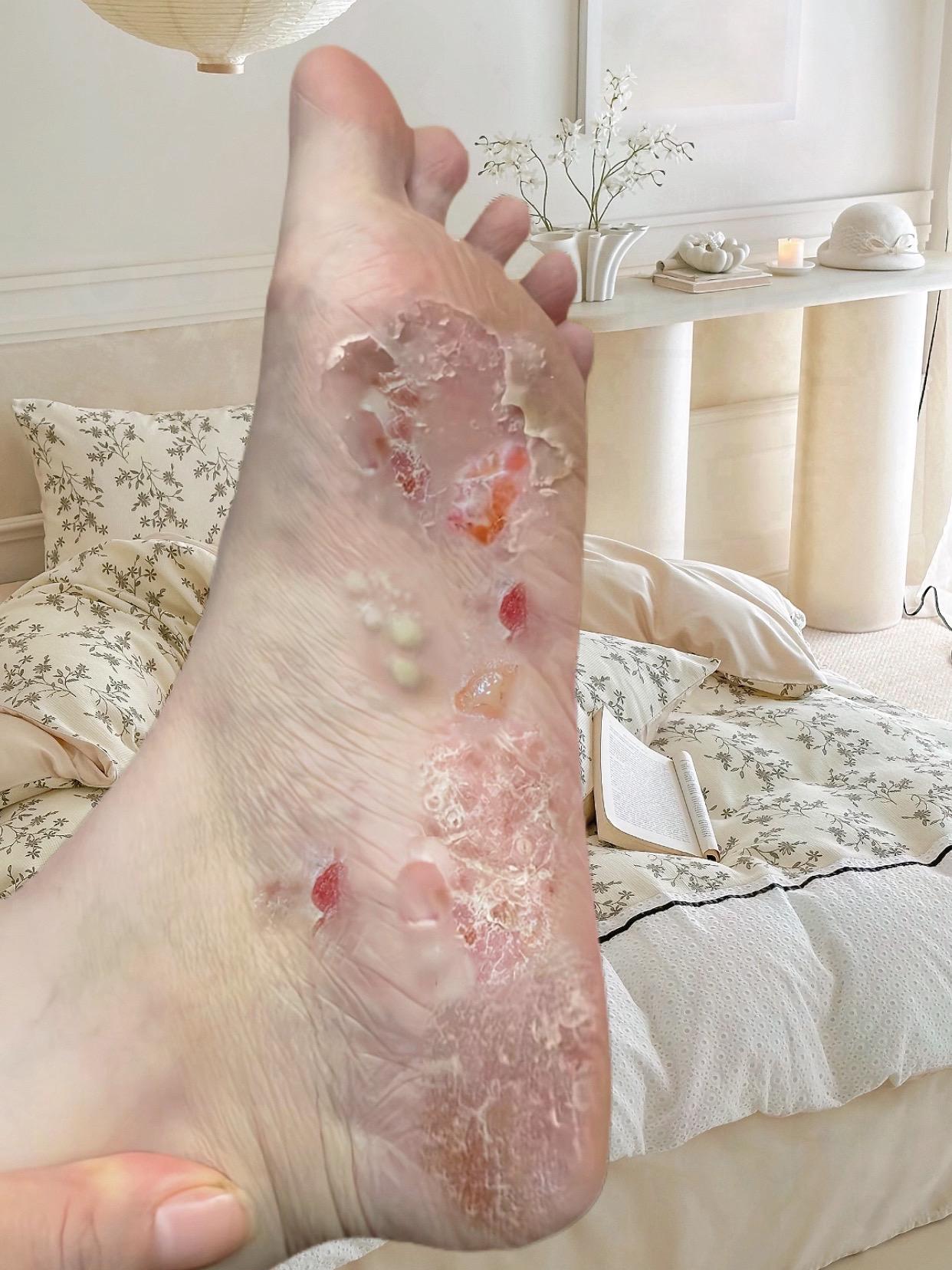 终于不痒了,不臭了,真的好开心!#足部护理#无处安放的小脚丫#夏天该有的样子#自信最美