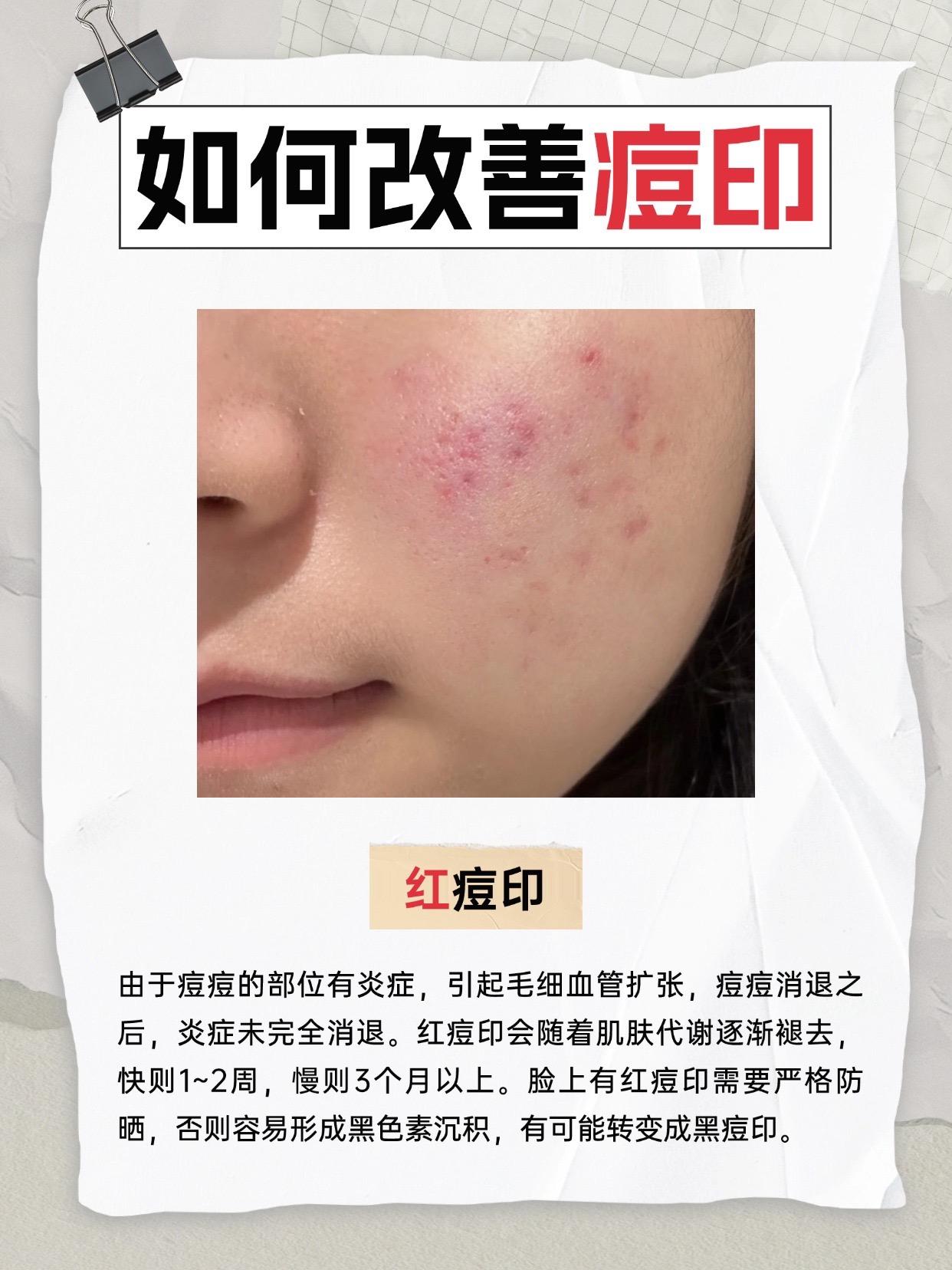告别痘印烦恼!轻松拥有光滑牛奶肌!还在为痘印困扰吗?这款「皙岛页岩油祛痘精华2.0」就是你的淡印小能手!温和不刺激,精准狙击黑色素,淡化红黑痘印超给力! 🌟 页岩油磺酸酯钠 调节皮肤微生态祛痘的同时养厚脸皮 🌟透明质酸钠 根源调节水油用下来T区出油量直接减半 🌟苦参+七叶树 修护肌肤屏障 抑制炎症一边褪红一边淡痘印 质地清爽不黏腻,油痘肌也能安心用~ 修护肌肤屏障抑制炎症一边褪红一边淡痘印精准瓦解顽固痘印,提亮肤色超给力!轻盈乳液质地,秒吸收不闷痘,敏感肌也能放心用~ 每天早晚坚持用,1瓶见效!红印、黑印通通淡化,肌肤重现透亮光泽~ ⚠️限时特惠,点击入手→解锁无瑕素颜自信!! #痘印 #祛痘#痘痘黑头粉刺拜拜 #护肤分享