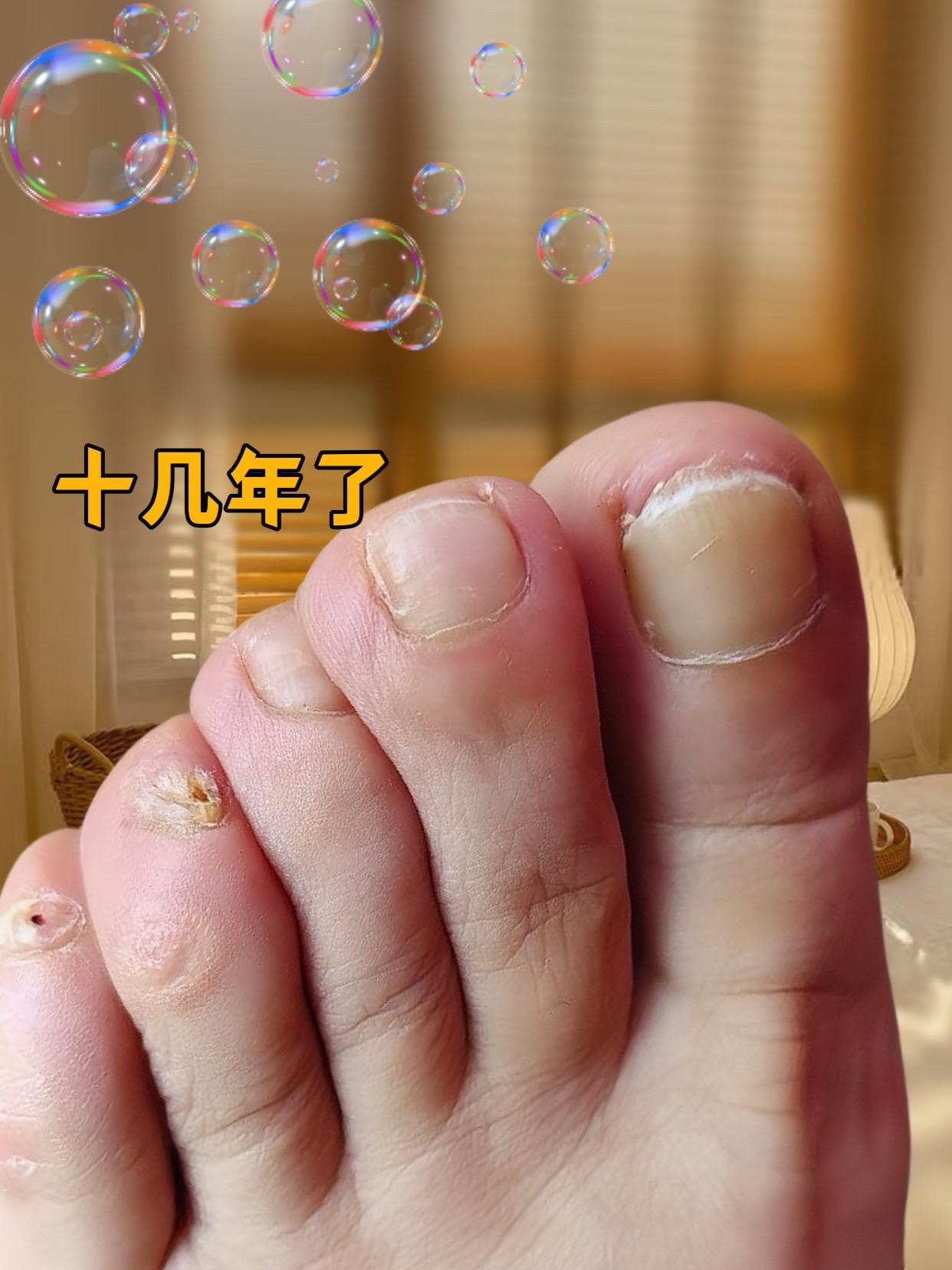 #灰指甲 #强烈推荐 #亲测分享 #自用好物分享 #爱了爱了 多年烦恼,成功上岸