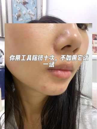 选对祛痘产品真的很重要,大糙脸必备的祛痘凝胶,有它在!脸上的 #痘痘就翻不了天!决定你颜值的不是五官而是好皮肤!#布卢艾尔祛痘凝胶