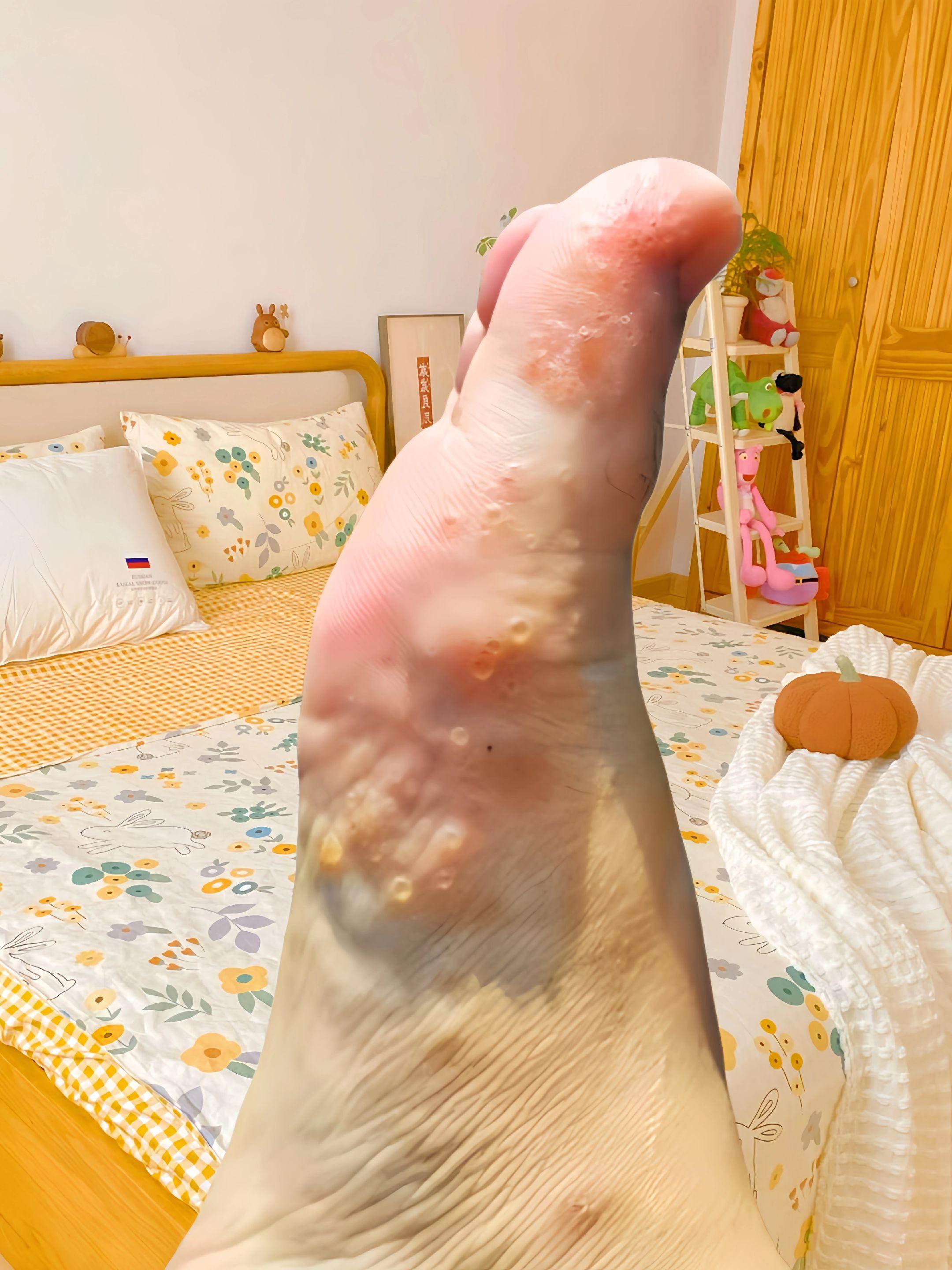 终于不痒了,不臭了,真的好开心!#足部护理#无处安放的小脚丫 #夏天该有的样子 #自信最美 #足部护理