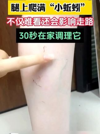 腿上青筋凸起红血丝,不仅难看还影响走路,教你一个方法轻松改善 #静脉曲张#静脉曲张怎么办 #静脉曲张手术 #静脉曲张老烂腿 #静脉曲张怎么治