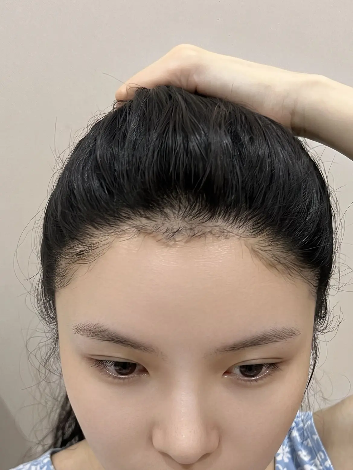 上海发际线真的能救回来吗?上次踩坑之后我对值发都有阴影了,总 - 抖音