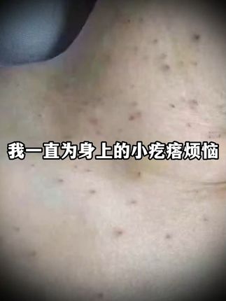 告别疣烦恼,轻松恢复光滑肌肤! 皮肤上长了小疙瘩?试试这款专门针对它的产品!#好物推荐#扁平疣#丝状疣#疣#自用好物分享