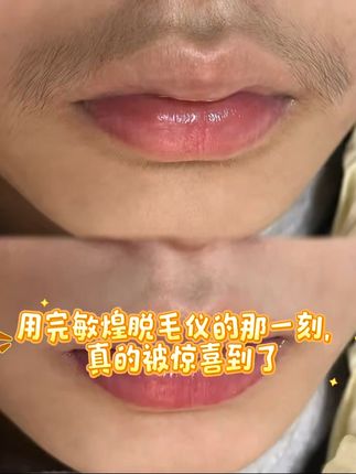 告别夏日尴尬毛毛,冰点脱毛仪轻松搞定! 这个夏天再也不怕腿上长毛了!有了它轻松搞定烦恼!#大学生 #好物推荐🔥 #脱毛仪 #好物推荐 #种草