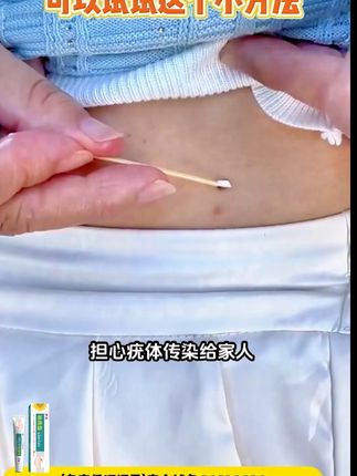 告别疣烦恼,轻松恢复光滑肌肤! 皮肤上长了小疙瘩?试试这款退热凝胶!#尖锐湿you #肉刺瘊子肉粒怎么祛除 #脖子上的小肉粒 #小肉粒 #疣体祛除