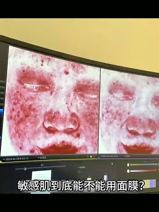 敏感肌救星!深层补水舒缓不再红肿 皮肤干燥起皮、易过敏?这款贴片面膜帮你改善!