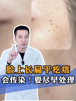 有疣的你不要一拖再拖,拿家里的它抹一抹,多年顽固疣淡化了! #疣 #脖子上的小肉粒 #hpv #小啾啾 #小肉粒