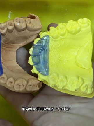 改善深覆合,专业牙科导板来帮忙! 牙齿咬合不正?改善方法来了!#好物推荐🔥#好物分享🔥#好东西一起分享#口腔健康#口腔