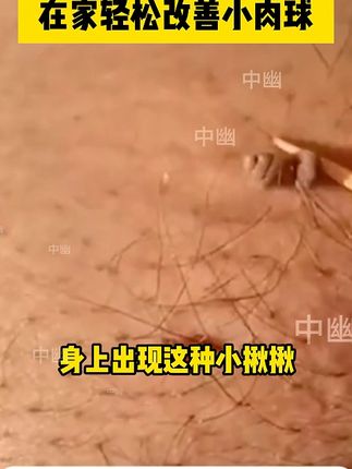 后悔没有早点知道,原来这么好用。 #丝状疣 #丝状疣祛除 #疣体祛除 #疣 #疣体祛除