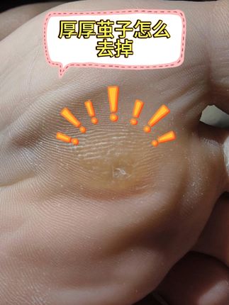 脚底硬皮太烦?这款软化剂轻松搞定! #老茧 #老茧怎么去除 #老茧脚垫 #老茧祛除 #老茧子