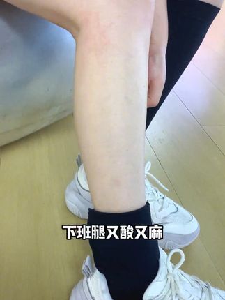 久站久坐腿累?这款静脉曲张袜让你轻松缓解! 腿脚酸麻胀疼?这款护具帮你缓解!#压力袜#弹力袜#静脉曲张#久坐久站