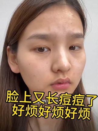 熬夜后长痘出油的救星!淡化痘印收缩毛孔神器来了! 皮肤痘痘问题多?这款液态精华帮你改善!#强烈推荐 #好物推荐🔥 #控油 #祛痘精华 #毛孔粗大