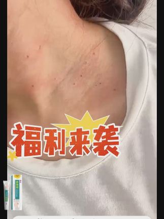 告别疣烦恼,轻松恢复光滑肌肤! 哪怕10年、8年都能用!选它!7天,只要7天!! #扁平疣 #丝状疣 #丝状疣祛除 #疣体祛除 #hpv感染