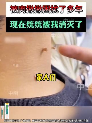 告别疣烦恼,轻松恢复光滑肌肤! 身上有疣的人有福了!试试这个办法,少走弯路!#扁平疣 #丝状疣 #疣体 #疣体祛除 #肉刺瘊子肉粒怎么祛除