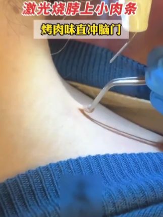 #脖子上的小肉粒 #亲测分享 #种草 ”