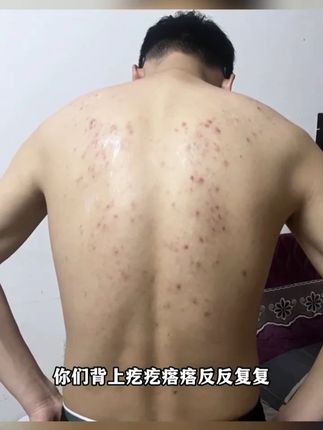 #自用好物分享  紫花草本抑菌止痒膏蚊虫叮咬家中必备,大人小孩都可以用,有运险险支持试用 不满意直接退,有需要的朋友放心入