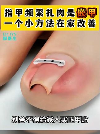 嵌甲就用正甲贴,在家处理不花冤枉钱#嵌甲#甲沟炎#国货
