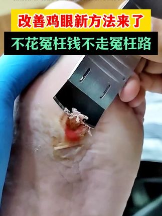 有鸡眼问题的不要错过,一招在家就能改善鸡眼 #鸡眼 #鸡眼去除小妙招 #老茧 zrl