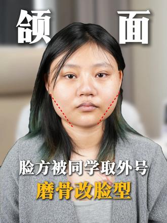 脸方被同学嘲笑,决心磨骨改脸型 #磨骨 #下颌角 #磨骨改脸型 #下颌角磨骨 #脸型