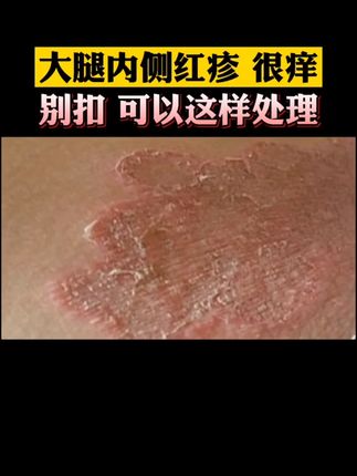 #大腿内侧痒#无限回购的宝藏单品#倪郎中#股藓是怎么来的#个人皮肤护理