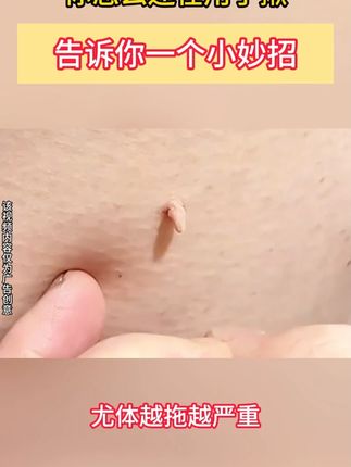身上上长疣体,别再拖了,赶紧试试这个方法吧!轻轻松松改善 #热点60秒 #好物分享🔥 #扁平疣丝状疣 #长了丝状疣怎么办