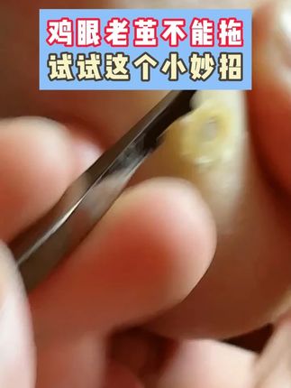父母十几年的老鸡眼 居然可以这样处理 #鸡眼跖疣 #专业修脚 #老茧 zrl