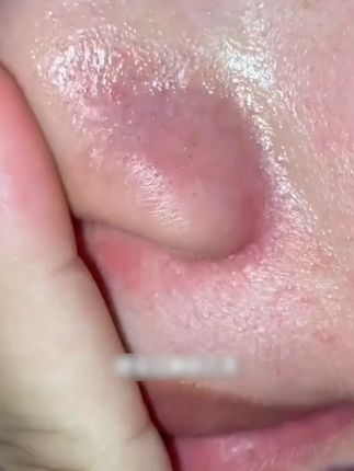 夏季爱出油,爱长黑头闭口的姐妹们,你们的救星来啦!#王大胖福利官 #泉兮去黑头三件套 #去黑头