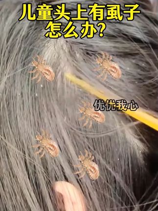 儿童头上长虱子怎么办 儿童头虱,仁和品牌,成分温和#头虱 #头上长虱子 #仁和复方百部酊喷剂 #虱子