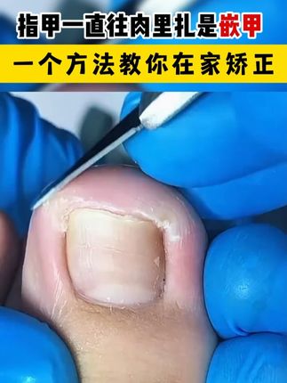 嵌甲就用正甲贴,在家处理不花冤枉钱#嵌甲#甲沟炎#国货